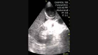 VSCAN Cholecystitis pocket ultrasound Colecistitis aguda eco de bolsillo [upl. by Bjorn444]