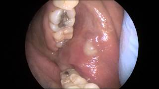 Acute Parotitis in HD [upl. by Thekla]