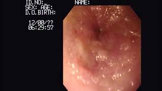 Video 2 Collection of duodenal biopsy samples via endoscopy [upl. by Trillbee]