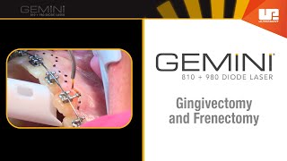 Gingivectomy and Frenectomy for Orthodontics  How to Use the Gemini™ Laser [upl. by Meekah]