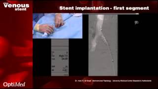 sinusVenous stent in practice [upl. by Adim]