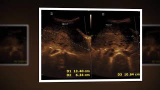 Ultrasound cases 451 of 2000  Puerperal sepsis [upl. by Tengler]