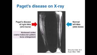 What is Paget’s Disease of Bone and how does bisphosphonate treatment work Dr Daroszewska explains [upl. by Bartlett328]