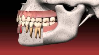 What is a dental bridge [upl. by Ativet]