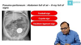 CONCEPTUAL RADIOLOGY ON MARROW  X ray signs in pneumoperitoneum [upl. by Hackathorn]