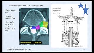 3 Key Ligaments of the Lumbar Spine and Their Related Pathology Disc Herniation Stenosis amp DISH [upl. by Esyned]