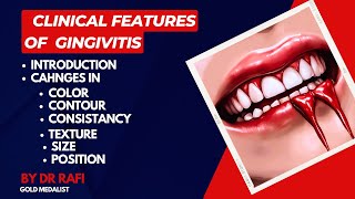 Clinical Features Of Gingivitis  Periodontology Lecture [upl. by Baldwin]