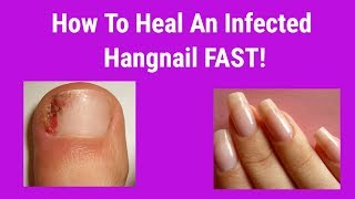 How To Heal An Infected Hangnail FAST [upl. by Eirrotal]