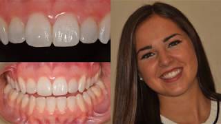 Composite Veneers with Dr Jenine Arab OMalley [upl. by Nnael589]