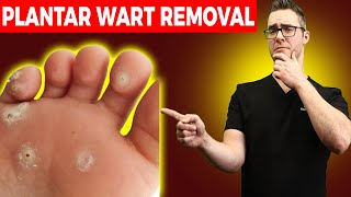 1 BEST Plantar Wart Removal How To Get Rid of Warts Treatments [upl. by Fong86]