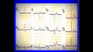 ECG normal et pathologique [upl. by Hodgkinson]