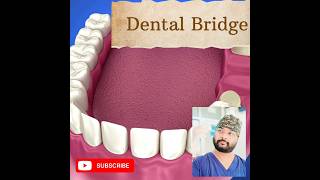 Dental Bridgeब्रिज preparation for Ceramic CrownBridge ytshorts prosthodonticsytvideoytshort [upl. by Hairehcaz839]