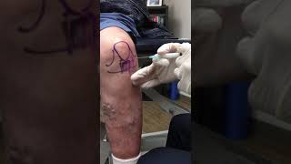 Anterior Knee Injection  Elite Sports Medicine  Lethbridge [upl. by Frants]