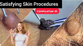 Care to skin and Relax to mind Satisfying skin tag removal compilation 01 DrAMAZINGSKIN [upl. by Haibot]