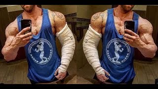 Tricep tear rehab VLOG BPC 157 and TB 500 [upl. by Lilybel]