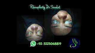 Rhinoplasty NoseReshaping for a very thick very wide nose drsaadatullah rhinoplastyinpakistan [upl. by Aer]