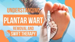 Understanding Plantar Wart Removal and Swift Therapy [upl. by Elder]