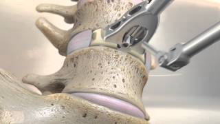 STALIF M™ MIDLINE II Surgical Technique Animation  Anterior Lumbar Interbody Fusion [upl. by Rez185]