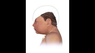 What is Microcephaly Causes Symptoms Treatment [upl. by Nnylram]