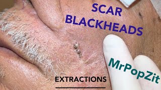 Giant blackheads imbedded in scar tissue extracted Common occurrence with surgical procedures [upl. by Ddarb]