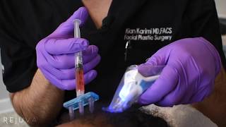 How to Do PRP PlateletRich Plasma TherapyProcedure  Hair Loss Treatment  Baldness  Alopecia [upl. by Alain]