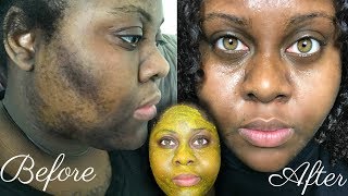 DIY Turmeric Face Mask for Hyperpigmentation amp Acne Scars ✨ [upl. by Arrim352]