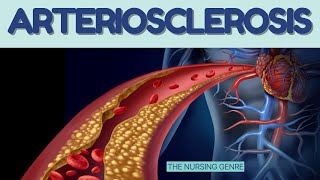 ARTERIOSCLEROSIS  Types  causes  Risk factors  clinical features atherosclerosis [upl. by Rae]