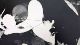 Bilateral Pulmonary Embolism in CTPA [upl. by Valeda472]