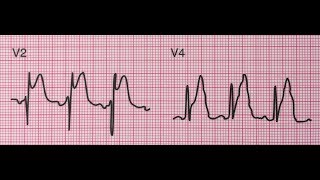 infarctus du myocarde en cours dinstallation aigue [upl. by Johnathon]