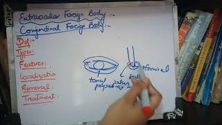 CONJUNCTIVAL FOREIGN BODY simple explanation [upl. by Cirad]