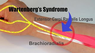 Wartenbergs Syndrome [upl. by Sielen223]