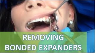 Removing a bonded expander RPE  Orthodontic Matters Episode 3 [upl. by Rennerb669]