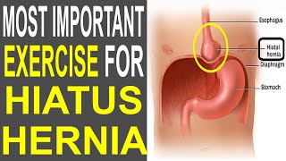 Most Important Exercise To Cure Hiatus Hernia  HEALTH MADE EASY [upl. by Ahsienat]