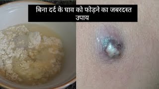 बिना दर्द के घाव को फोड़ने का जबरदस्त उपाय  ulcer skincare skincaretips [upl. by Ezzo]