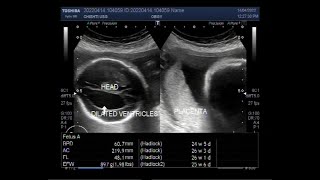 Dilated lateral ventricles with Pregnancy of about 26 weeks [upl. by Anina]