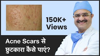 Acne Scars Causes amp How To Get Rid Of Acne Scars Acne Scars से छुटकारा कैसे पाएं In HINDI [upl. by Myrtice]