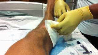 R Leg Abscess I amp D [upl. by Kreindler]