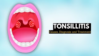 Tonsillitis Causes Signs and Symptoms Diagnosis and Treatment [upl. by Kerman]