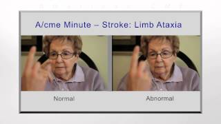 Stroke limb ataxia [upl. by Urita]