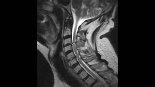 Cervical canal stenosis and spinal cord atrophy [upl. by Rim332]