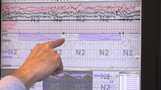 Reading Sleep Study Results Identifying Sleep Apnea [upl. by Entroc]