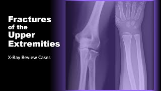 Fractures of the Upper Extremities on XRay radiology xray doctor [upl. by Lleznov]