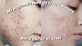 Dos meses de tratamiento para el acné  doxiciclina clindamicina y epiduo gel [upl. by Aerdnaeel]