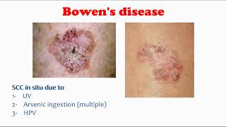 Bowens disease [upl. by Boycey]