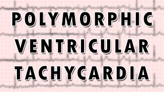 Ventricular Tachycardia [upl. by Eednar]