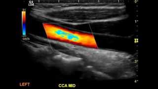 Normal Carotid Duplex [upl. by Barton]