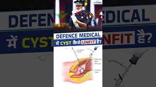 Can Cysts Cause Rejection in SSB Medical [upl. by Mendoza]