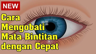 Cara Mengobati Mata Bintitan dengan Cepat [upl. by Ardien]