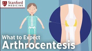 Arthrocentesis – What to Expect [upl. by Juna]