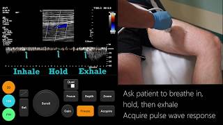 Ultrasound Tutorial DVT  Lower Limb Veins  Radiology Nation [upl. by Osman]